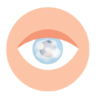 Cataracts
